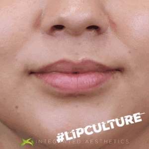 Dermal fillers